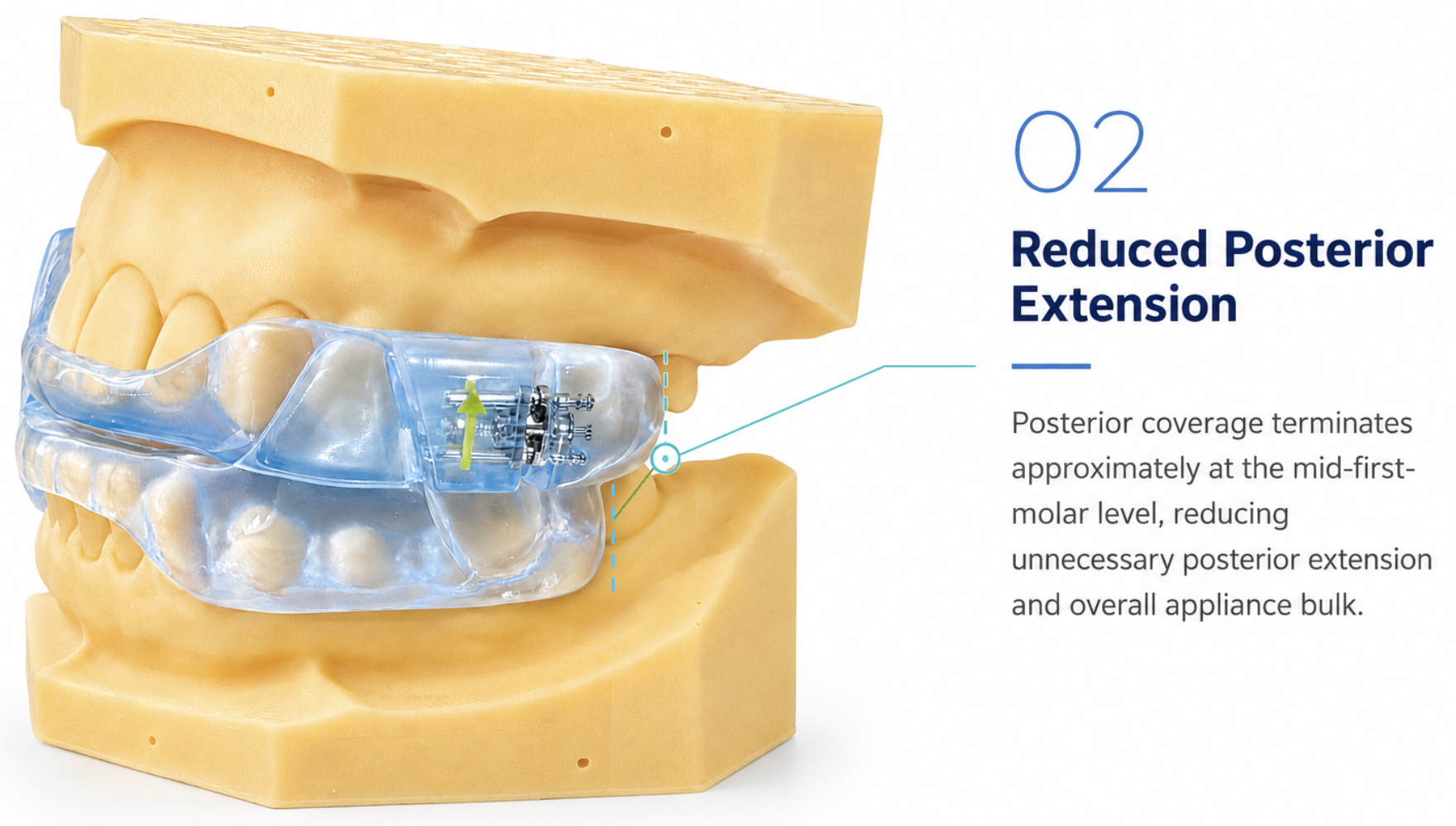 Master Sleep 10™ appliance — reduced posterior extension